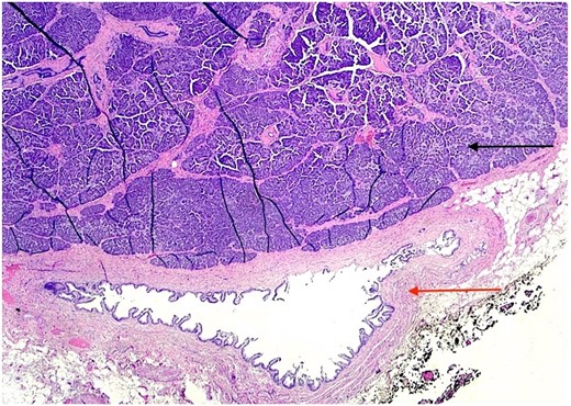 H & E stain 20×: Ectopic pancreatic parenchyma (black arrow), present in the gallbladder wall, composed of mucosa with underlying muscularis and adventitia (red arrow).