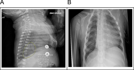 (A) A 3.8 × 2.6 × 2.8 cm ovoid hazy opacity is projecting in the right hemithorax in the expected location of the right lower lobe. (B) Right lower lobe 3.8 cm faintly opaque lesion may represent pulmonary sequestration rather than duplication cyst or other mediastinal lesions.