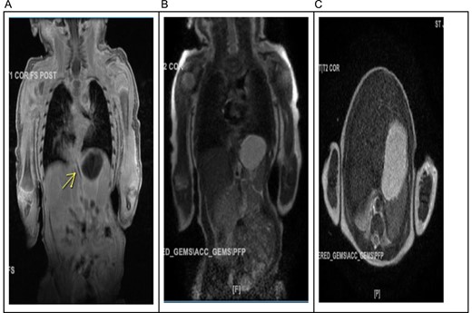 (A) The arterial supply to what appears to be a right lower lobe sequestration arises from the celiac trunk and there may be either a 2nd smaller artery arising more distally or a draining vein to the spleno-portal confluence. (B) The major venous drainage appears to extend to the right inferior pulmonary vein. (C) In the right lower lobe there is a 2.9 × 2.6 cm mass containing internal vascular architecture and suggestive of a sequestration.