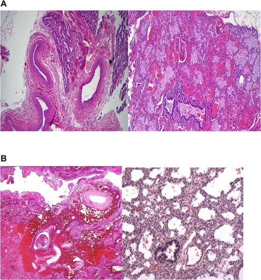 (A) Sections show lung tissue with thick walled large vessels in the septa and near the hilum representing a systemic arterial supply. These findings are consistent with ILS. (B) Hemorrhagic lung parenchyma that was covered by pleura, supplied by thick walled large vessels and clinically located outside the lung thus satisfying the criteria for ELS.