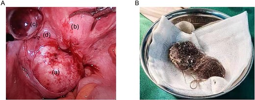 Intra-operative findings. (A) A cyst measuring about 6 × 6 × 5 cm is observed in the left broad ligament: (a) teratoma (b) uterus (c) ovary (d) broad ligament. (B) A significant amount of hair and grease are observed in the capsule cavity.