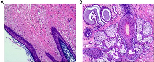 Histopathological features of mature ovarian teratoma.