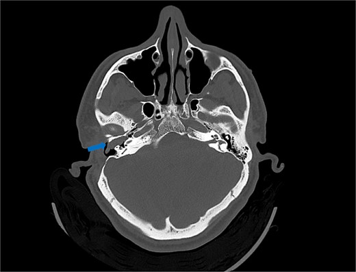 Axial view of computed tomography (CT) scan showing a polypoid soft tissue lesion in the floor of the external auditory canal, extending into the middle ear cavity, with erosion of the bony scutum (arrow).
