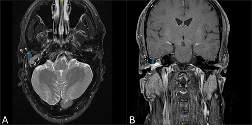 (A) Axial MRI view demonstrating a homogeneous soft tissue mass with slightly high signal intensity (arrow). (B) Coronal MRI view revealing a hypervascular mass located in the right epitympanum, without evidence of diffusion (arrow).