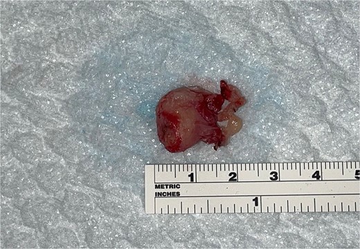 Right ear mass excision: 2-inch oval hypervascular mass surgically removed from the right middle ear.