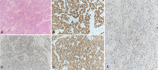Histological sections show sheets of neoplastic cells filling the subcutaneous tissue. (A) Some of the cells show plasmacytoid morphology. No necrosis, mitotic figures, or significant cytological atypia is seen. The neoplastic cells are positive for CD56 (B), and the cytokeratin cocktail shows weak cytoplasmic staining (C). Synaptophysin (D) and chromogranin immunostains (E). These findings are diagnostic of a well-differentiated neuroendocrine tumor, grade 1.