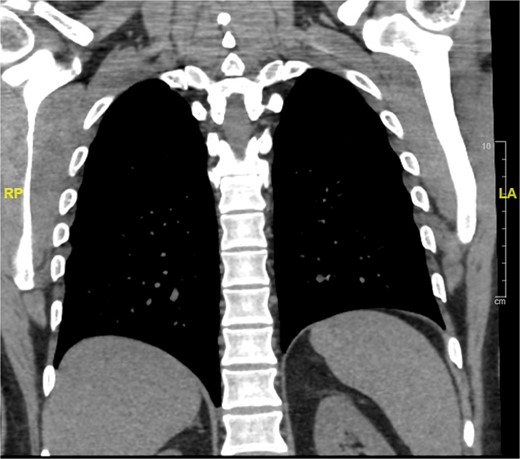 Stable bilateral small pulmonary nodules seen within the lower lobes of the lung.
