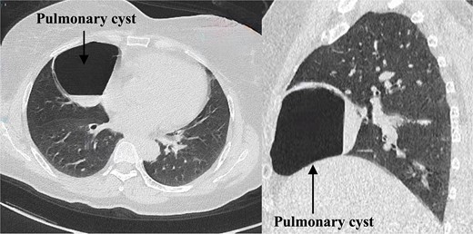 Preoperative enhanced chest computed tomography.