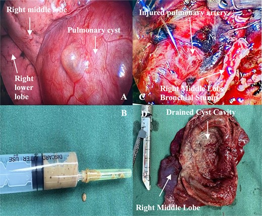 Intraoperative images. (A) Cyst in the right middle lobe and surrounding structures. (B) Pus aspirated from the cyst cavity. (C) Injured pulmonary artery. (D) Resected right middle lobe and opened cyst.