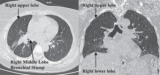 Postoperative 1-month follow-up non-contrast chest computed tomography.