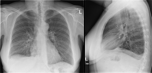 Chest X-ray during visit to the emergency department showing bilateral pleural effusion.