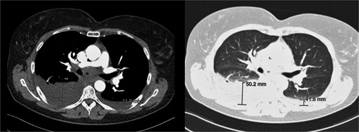CT-scan during visit to the emergency department confirming the pleural effusion attributed as reactive or postoperative.