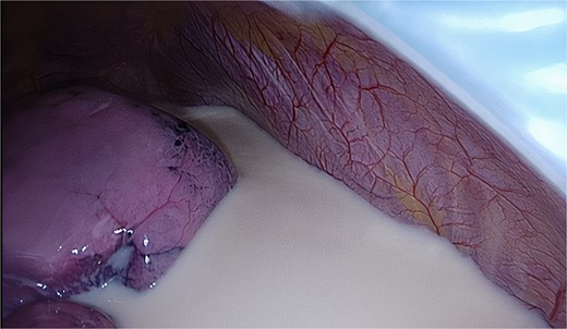 Intra-operative view of chyle.