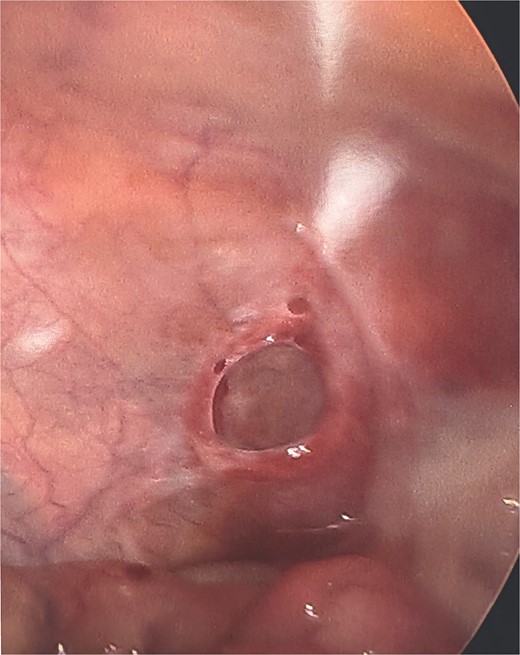 Peritoneal invagination after the small bowel was reduced.