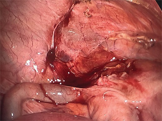 Intact peritoneum at the base of the peritoneal invagination hernia after incising the peritoneum.