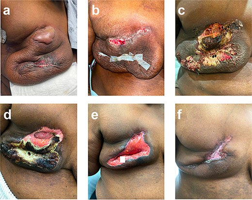 Right breast (a) POD 9, day three of antibiotics, large bulla, erythema, and incision-site drainage; (b) POD 12, two days following debridement and washout, day six of antibiotics; necrotic tissue removed, some dehiscence and erythema; (c) POD 15, started prednisone, significant dehiscence, induration, and large areas of necrosis; (d) POD 24, day nine of steroids, spread of necrosis is limited; (e) POD 40, day 25 of steroids, necrotic tissue removed; (f) POD 87, day 43 on infliximab, scar forming.