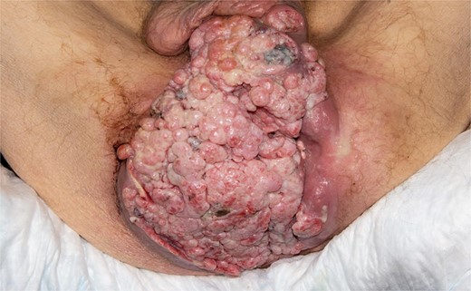 Perineal mass as examined in the lithotomy position.