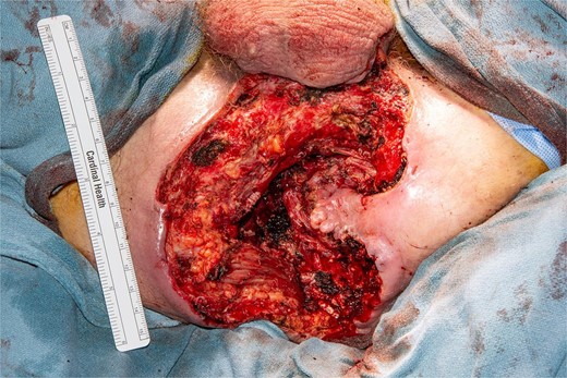 Perineal wound after wide local excision, patient in the lithotomy position.