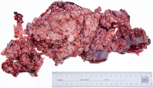 Gross photo of wide local excision, measuring 28 × 13 × 6 cm.