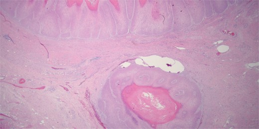 Histologically the specimen was a well-differentiated squamous cell carcinoma with pushing borders without any infiltrative invasion, specifically distinguishing it from conventional invasive squamous cell carcinoma.