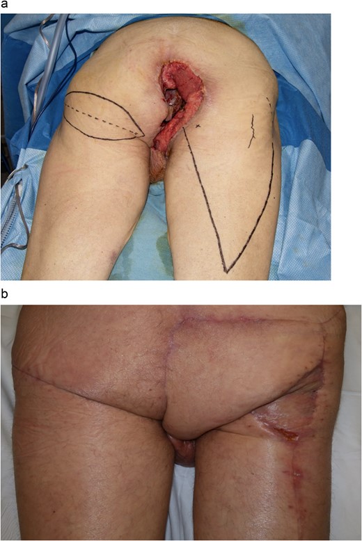 With patient in prone position, (a) marked pedicle flap reconstructions. Using an inferior gluteal fold fasciocutaneous flap on the left side, and gluteal thigh flap on the right side. (b) Final reconstruction result at 2 weeks.