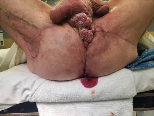 In lithotomy position, recurrence at the anterior/scrotal aspect of perineal incision, with recurrence identified also at posterior and right lateral aspect underneath flaps.