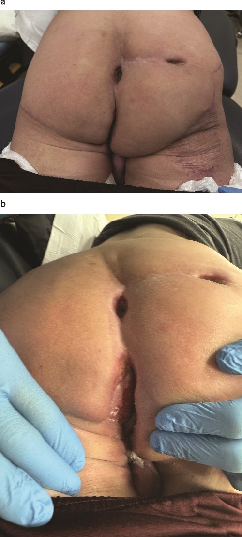 Wounds to perineal defect healing by secondary intention 6 weeks after radiation therapy. (a) Patient in prone position. (b) Patient in left lateral decubitus position