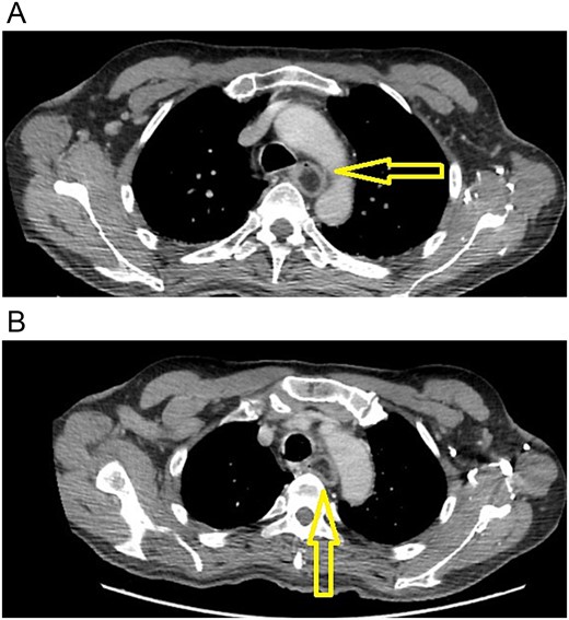(A) CT scan: esophageal polyp is seen in the esophageal lumen. (B) CT scan: esophageal polyp completely obstructs but does not invade the esophagus.