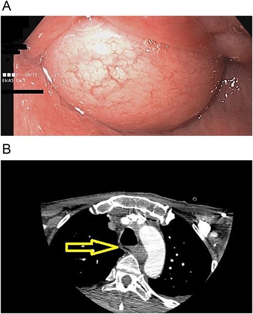 (A) Endoscopy, the polyp obstructs the esophagus's lumen. (B) CT scan: esophageal polyp size has increased in size over a year.