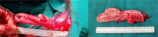 (a) The polyp is seen being removed from the esophagus. (b) The complete 14 × 3-cm multilobulated esophageal polyp.