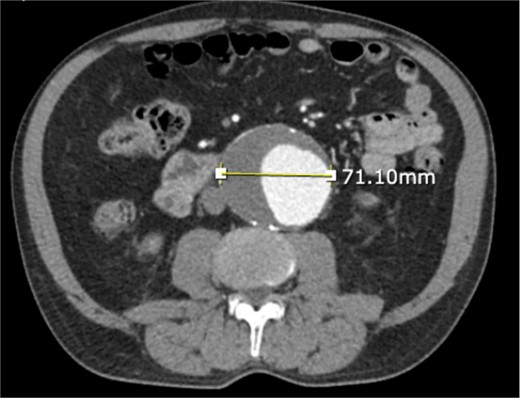 CT angiogram of abdominal aorta and iliofemoral artery axial view.