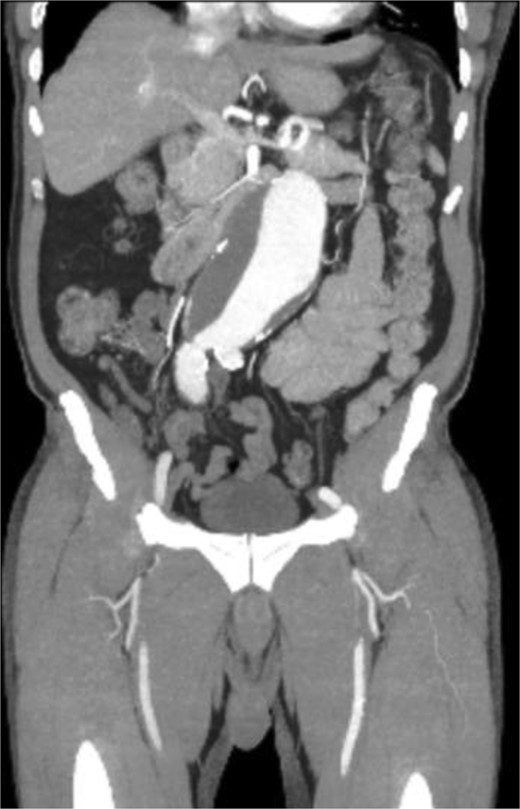 CT angiogram of abdominal aorta and iliofemoral artery coronal view.
