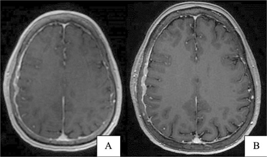(A) Brain CT without contrast shows no acute hemorrhage or large vessel territory infarct. (B) Brain MRI without contrast: right parietal calvarial signal abnormality with subjacent dural thickening. There is no definitive parenchymal involvement.