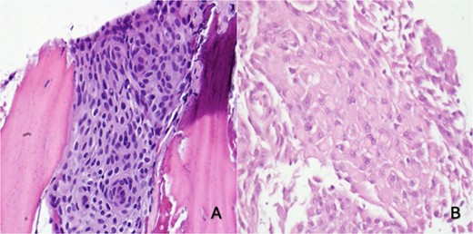 (A) Right skull and scalp partial thickness craniectomy shows syncytial growth pattern with meningothelial whorls favoring intraosseous meningioma (H&E 400×). (B) Skull and dural excision: focal rhabdoid morphology (H&E, 400×)