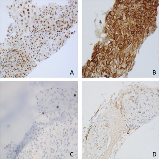 Immunohistochemistry shows tumor cells are positive for (A) PR, (B) SSTR2, (C) Ki67 < 1%, and (D) EMA (400×).