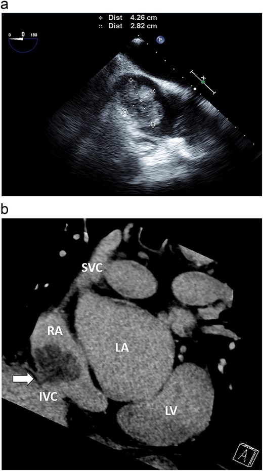 (a) Transesophageal echocardiography demonstrated that the mass was 42 × 28 mm in size, located in the inferior cavity of the right atrium, and was multi-lobulated, pedunculated, and highly mobile. (b) Coronary CT revealed a stalk on the endocardium of the IVC orifice (white arrow).