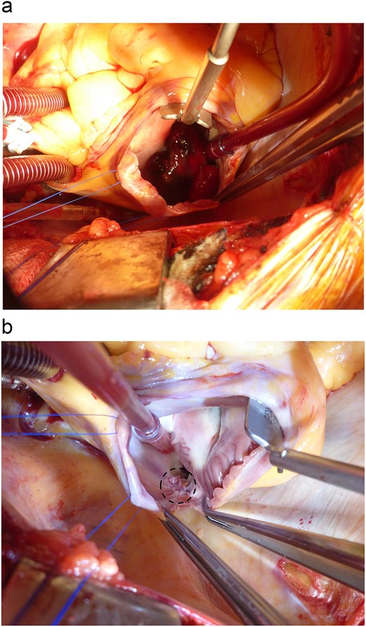 Intraoperative findings. (a) With two venous cannulas both in the superior vena cava and the main pulmonary artery, cardiopulmonary bypass was started. Through a lateral right atriotomy, a lobulated, gelatinous, and smooth surfaced tumor, 43 × 38 mm in diameter, was found. (b) The deficit of the endocardium (black dot circle) was closed with autologous pericardium.
