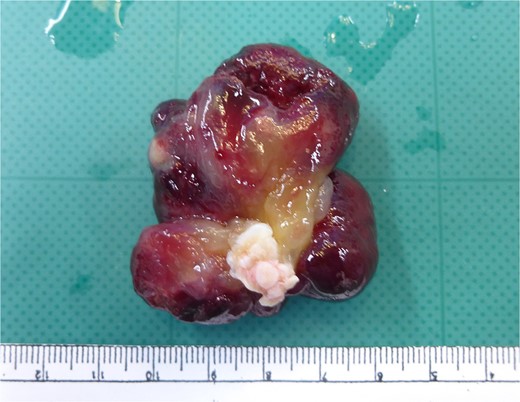 The tumor was completely resected including the endocardium attached to its base.