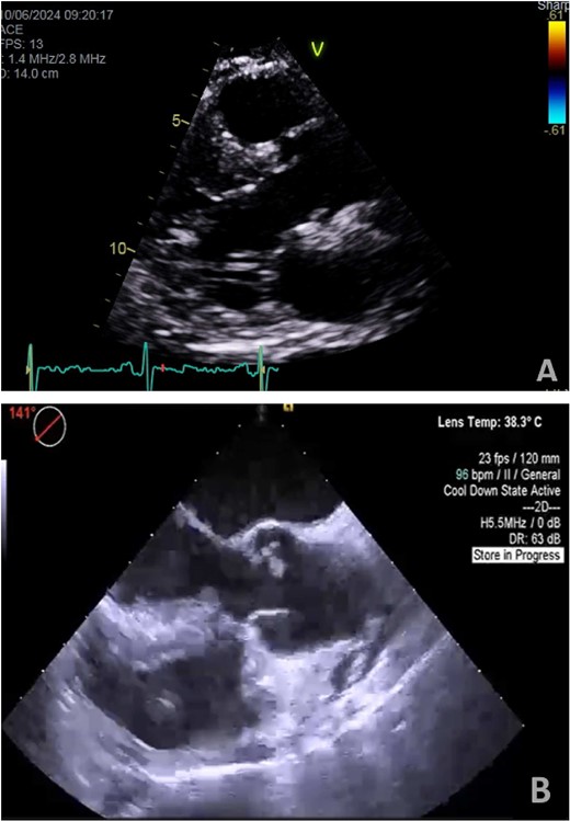 (A) Preoperative transthoracic echo (Para sternal long axis view) showing clear aortic valve cusps with no mass. (B) Intraoperative transesophageal echo (midesophageal long-axis view at 140°–150°) showing mass attached to ventricular surface of NCC of aortic valve.