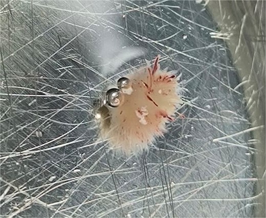 PFE of aortic valve following excision.