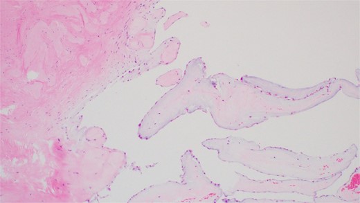 Hematoxylin and Eosin (H&E) stain of the tumor showing multiple branching fronds of paucicellular fibroelastic tissue lined by a single endocardium. Magnification power ×100.