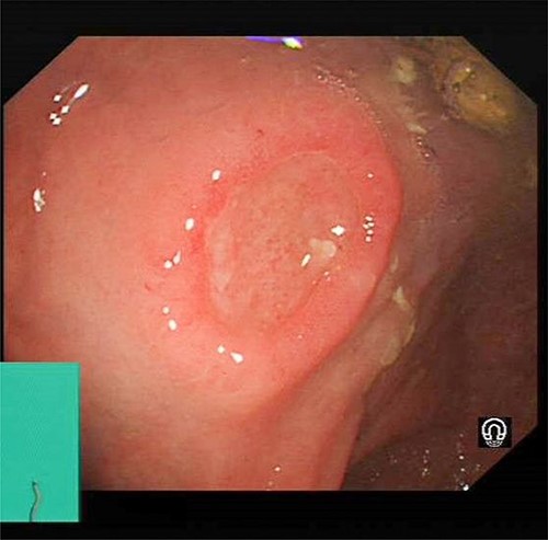 Colonoscopy images of a 64-year-old male with rectal mass. The images show a 10 mm elevated lesion with central ulceration in the rectum, ~5–6 cm from the anal verge.