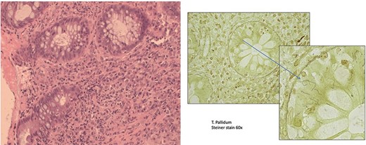 Rectal syphilis in a 64-years-old male with rectal mass (A). This section shows active chronic proctitis (Hematoxylin & Eosin stain, ×20 magnification) H + E 20×. (B) Treponema pallidum (Steiner stain, 60× magnification).