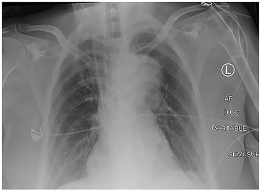 Erect chest X-ray demonstrating left pleural effusion and an unfolded, dilated aortic arch.