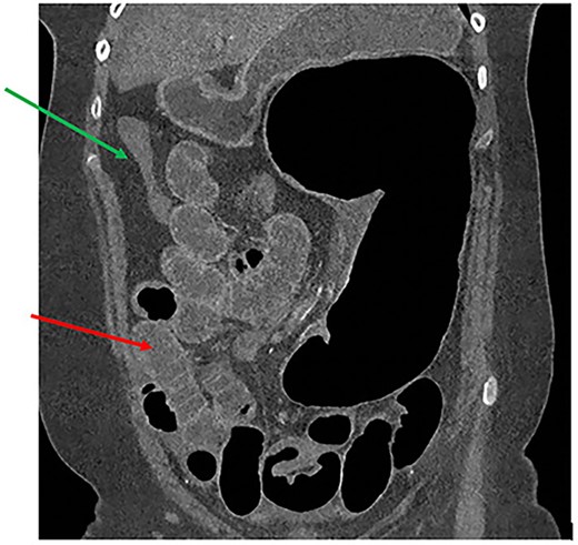CT thorax, abdomen and pelvis coronal view demonstrating a distended, twisted caecum, caecum in the left upper quadrant, small bowel distension (red arrow) and a decompressed ascending colon (green arrow).