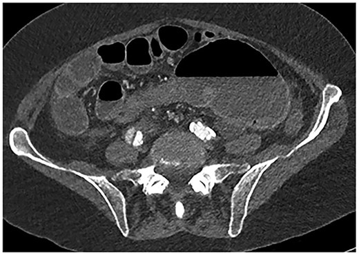 CT abdomen axial view demonstrating the Beaking sign—a progressive tapering of afferent and efferent limbs leading into the twist.