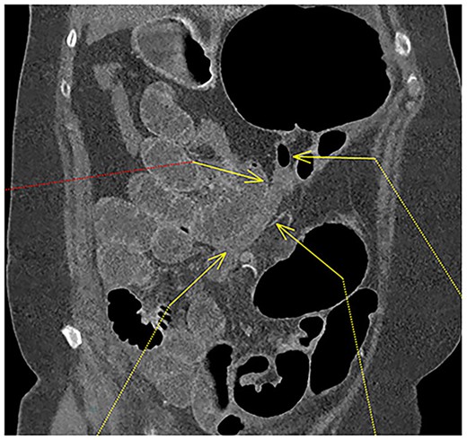 Fluid-filled mid to distal appendix with some gas in the proximal part outlined with yellow arrows. Appendix is seen within the upper abdomen, indicating an increased likelihood of caecal volvulus.