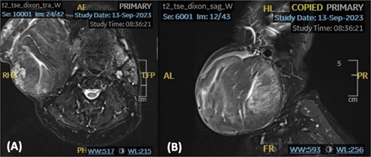 An axial (A) and sagittal (B) T2-weighted MRI showing a rounded well-defined heterogeneous lesion with soft tissue signal.