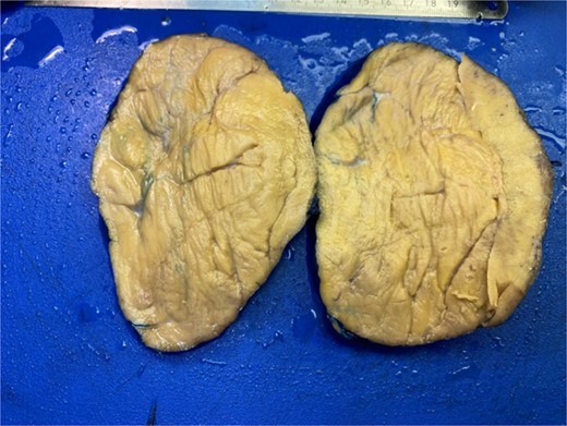 Gross pathology of the tumor.