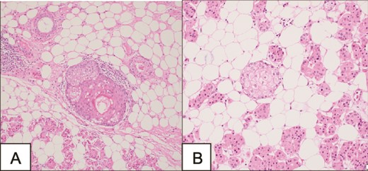 Microscopy demonstrating a tumor of prominent oncocytes organized in tubular structures, admixed with fatty tissue containing mature adipocytes.